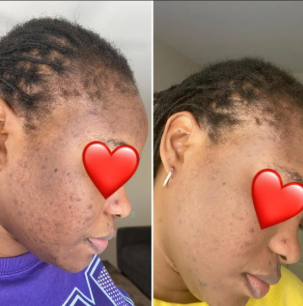 Norix Kojic Acid & Tumeric Spray